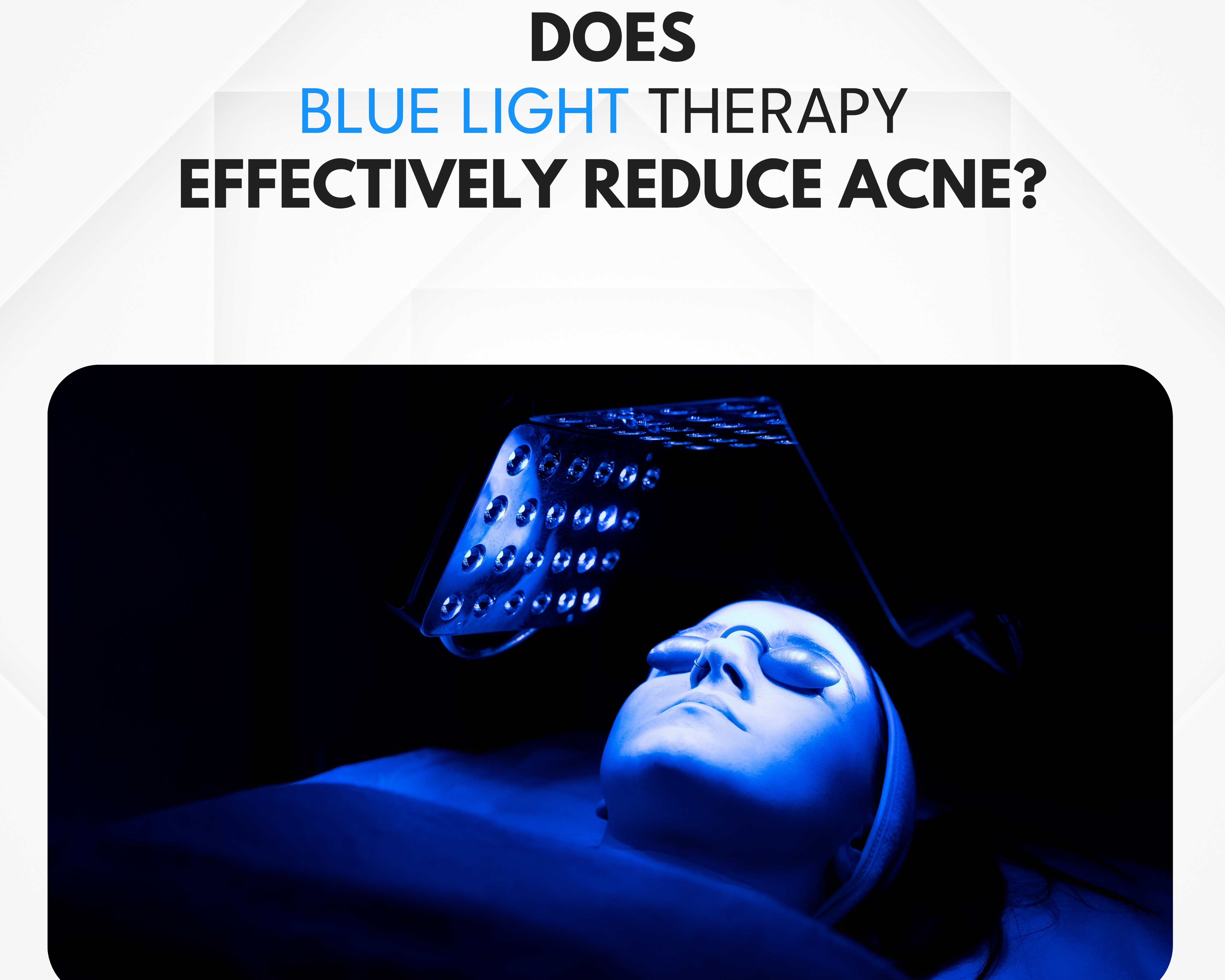 How Effective is Blue Light Therapy for Acne?