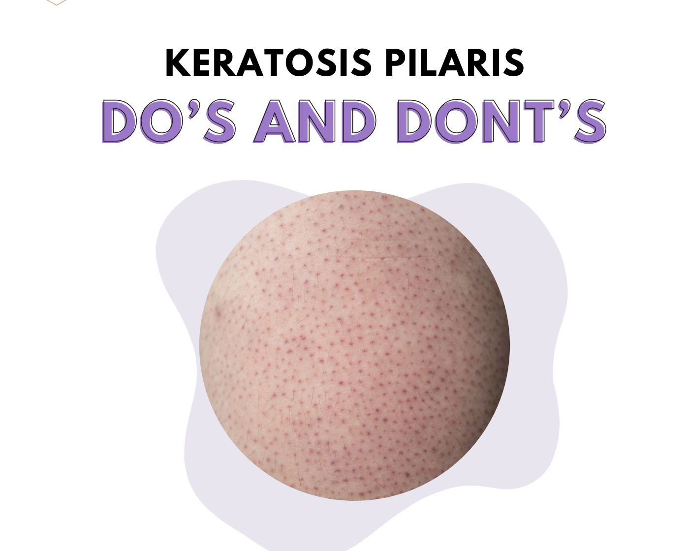 Keratosis Pilaris  Do’s and Dont’s