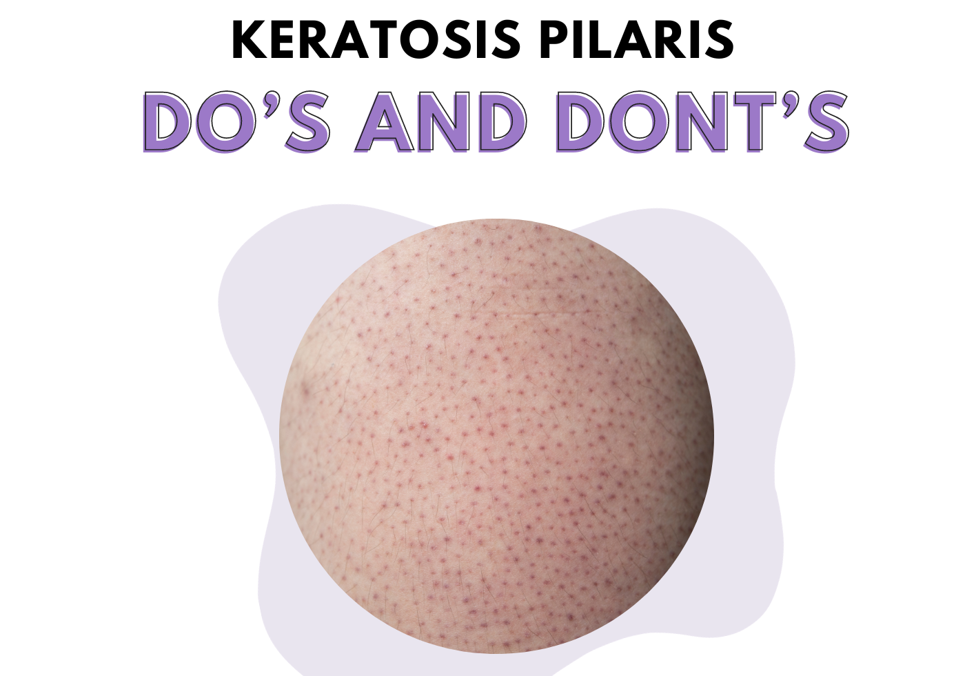 Keratosis Pilaris  Do’s and Dont’s