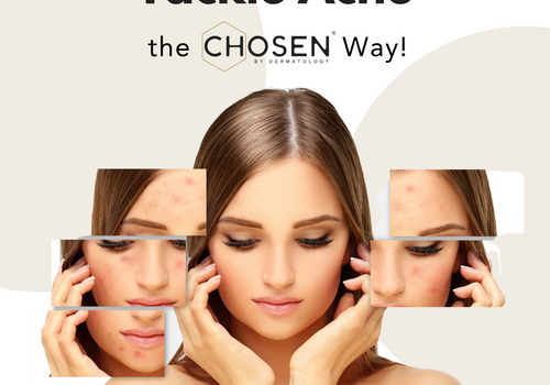 How to get rid of Acne?