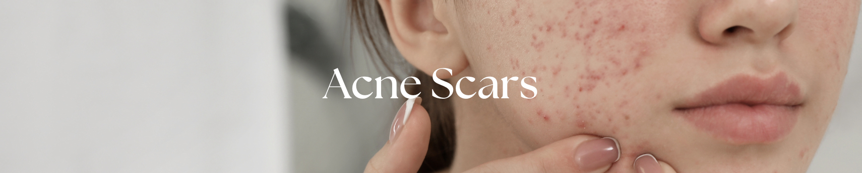 Best Skin Care Products for Acne Scars