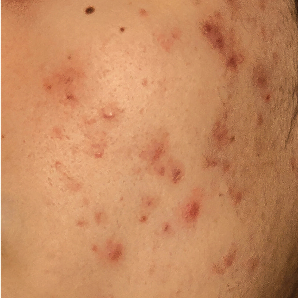 Acne-concern