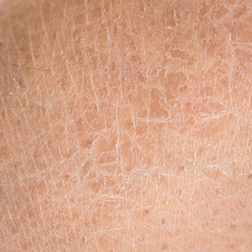 Dry_Skin_281c247f-6d67-4161-ac18-86dcc06c7a96.png