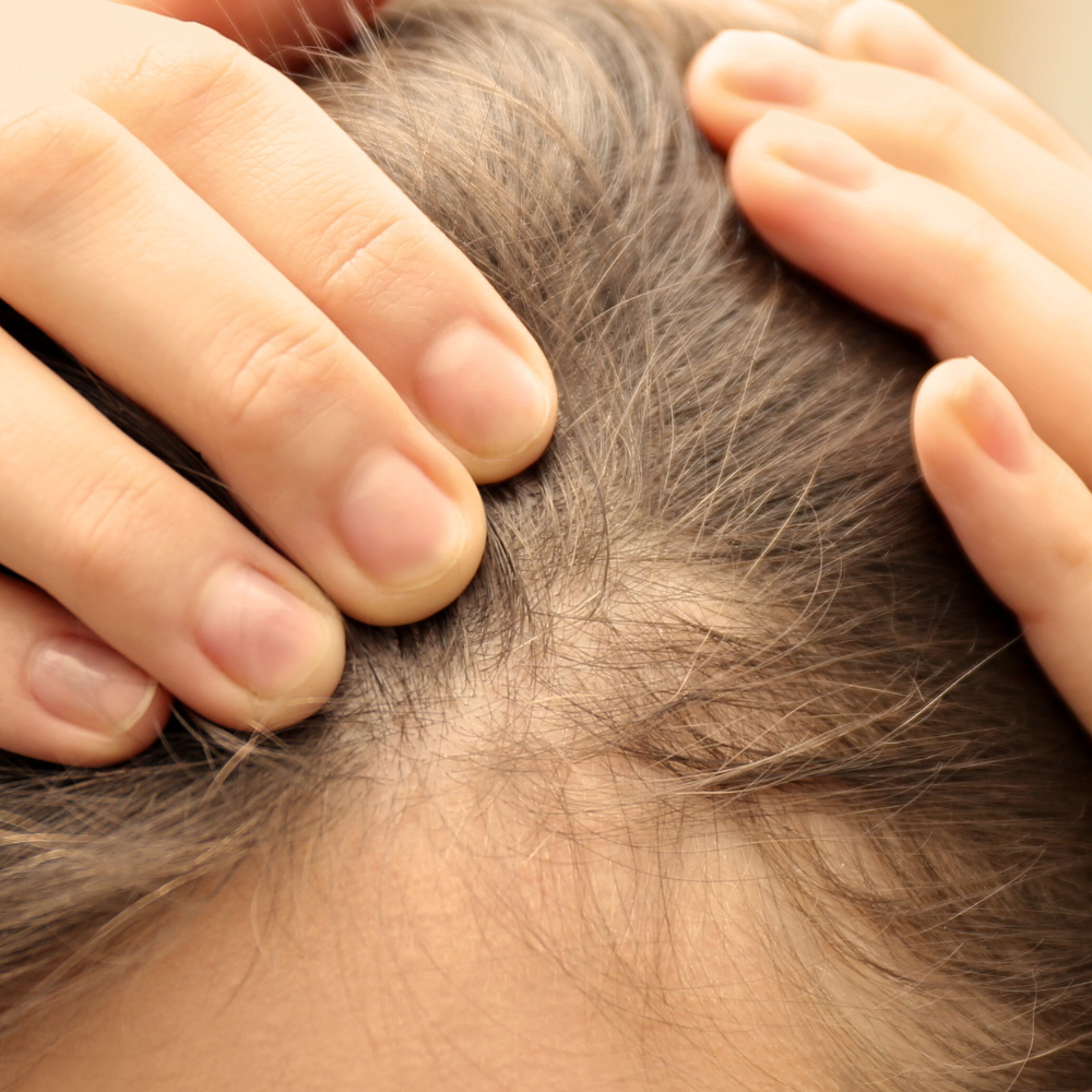 Female_Pattern_Hair_Loss_b0022794-ab46-40af-9927-efc30b2f26b8.png