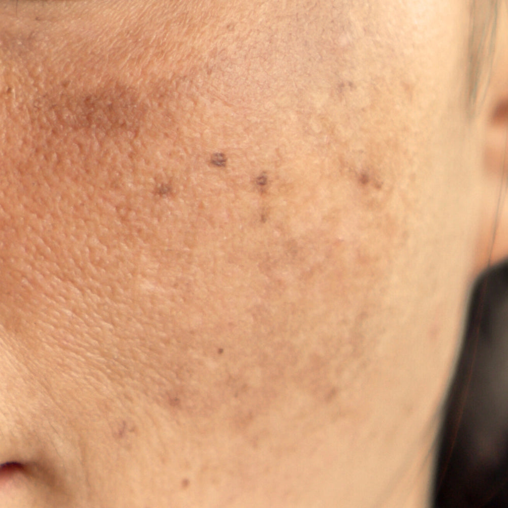 Melasma-concern