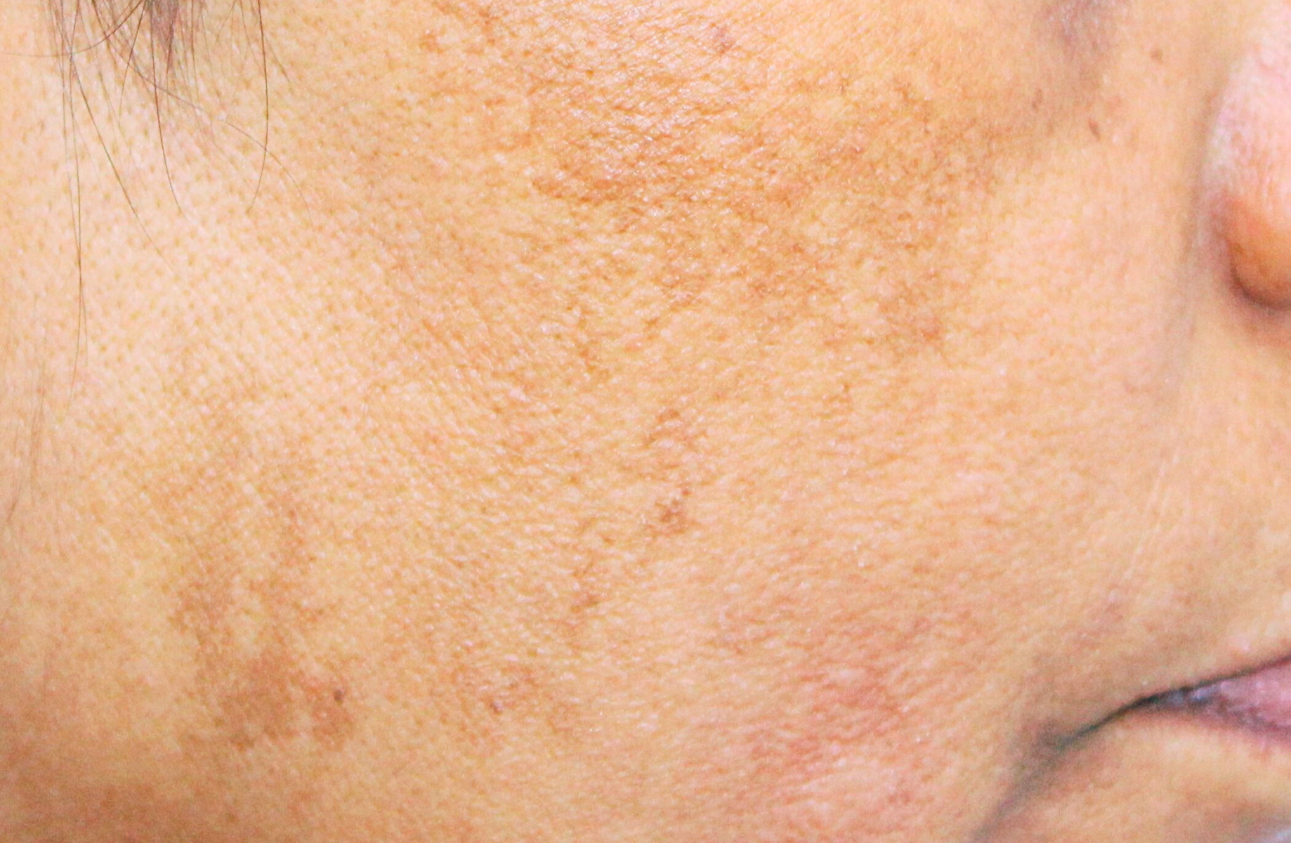 Melasma