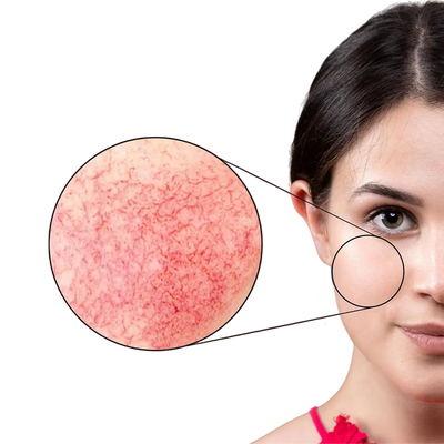 Does Your Skin Need Re(d)covery?